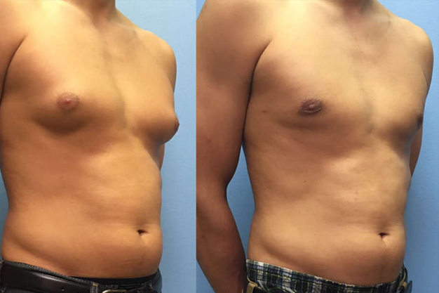 gynecomastia surgery in surat